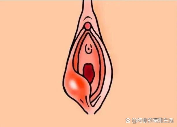 女性前庭腺肿大图片图片