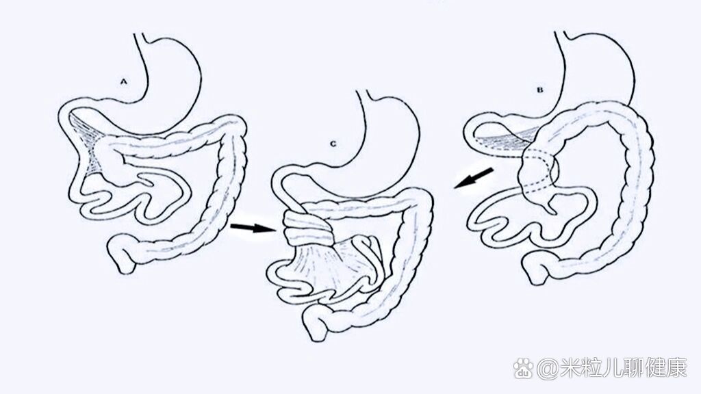小肠扭转 全网资源