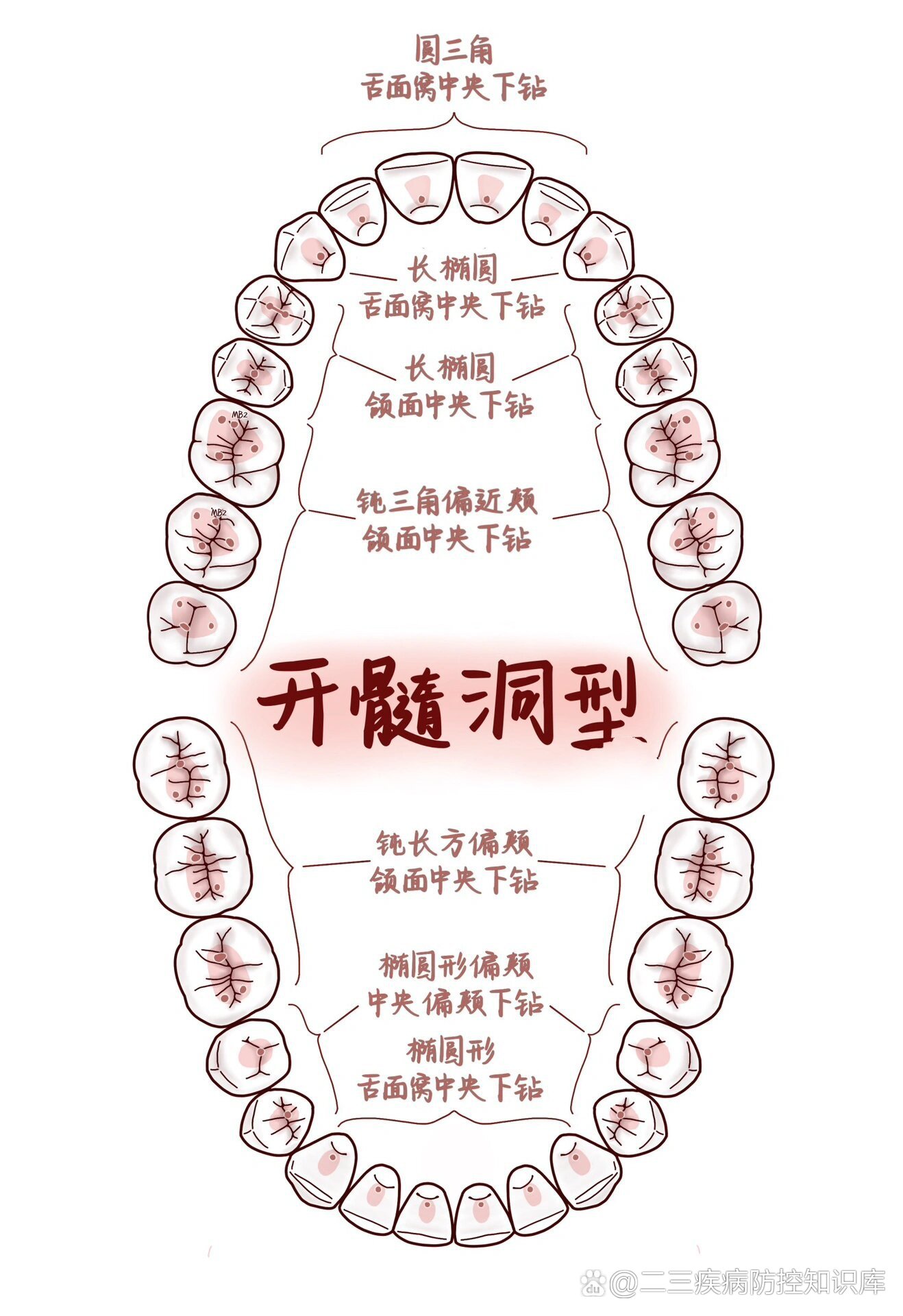 下颌六的开髓形态图片图片