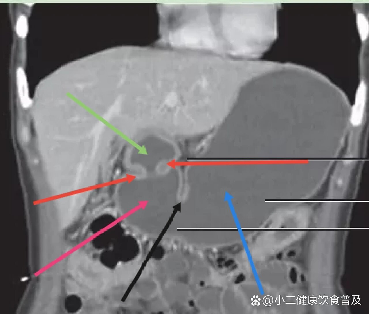 胃的ct横断面解剖