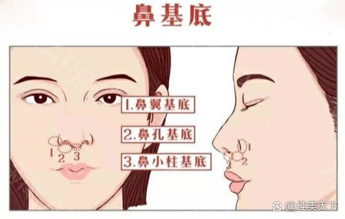  br>鼻小柱基底:鼻小柱基底位于鼻小柱下方区域.
