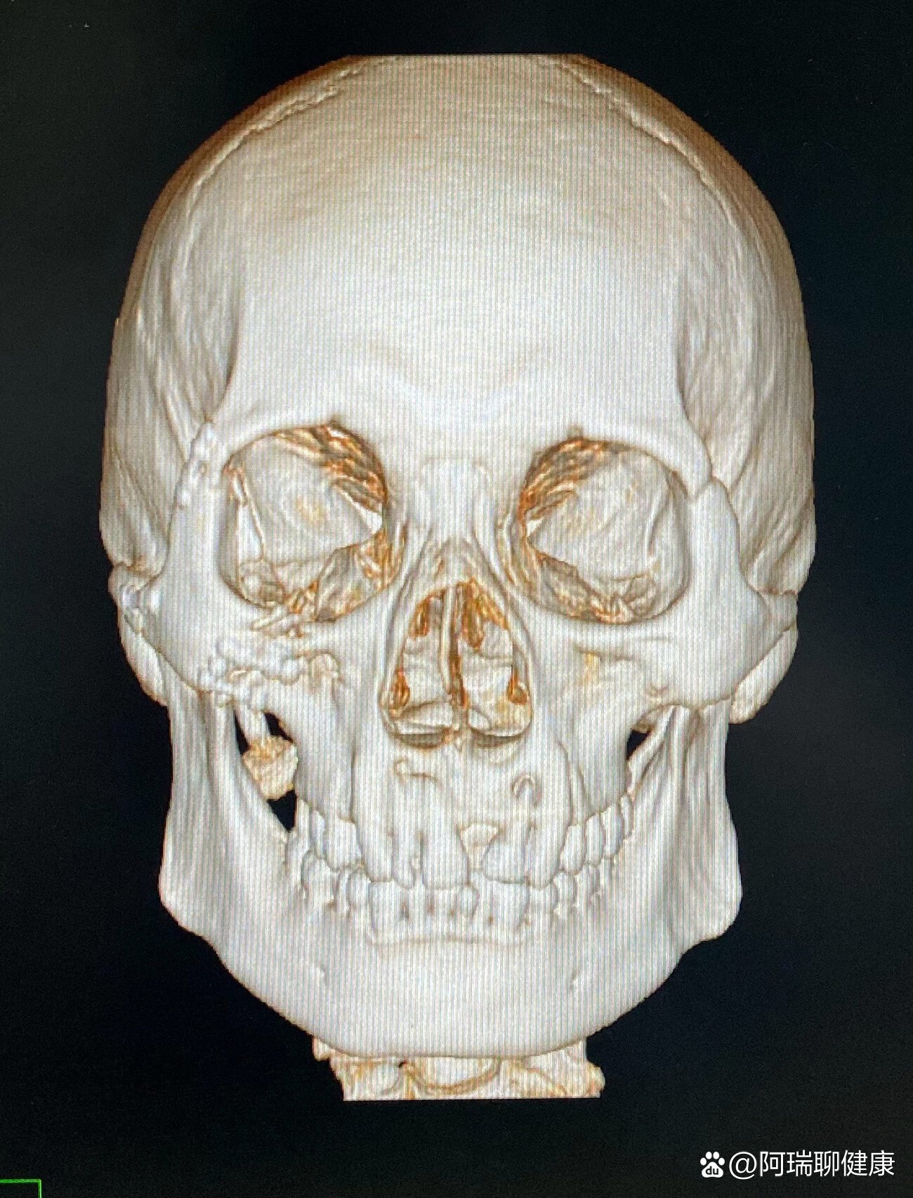 颧骨弓骨折图片