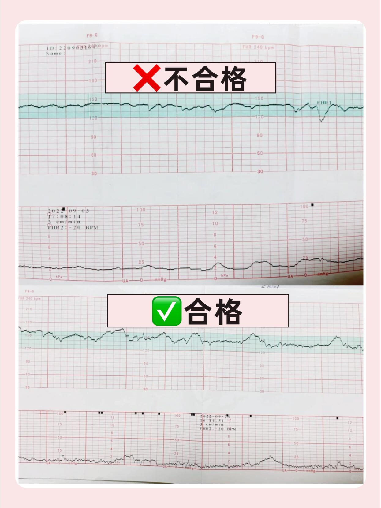 教大家轻松看懂胎心监护图73