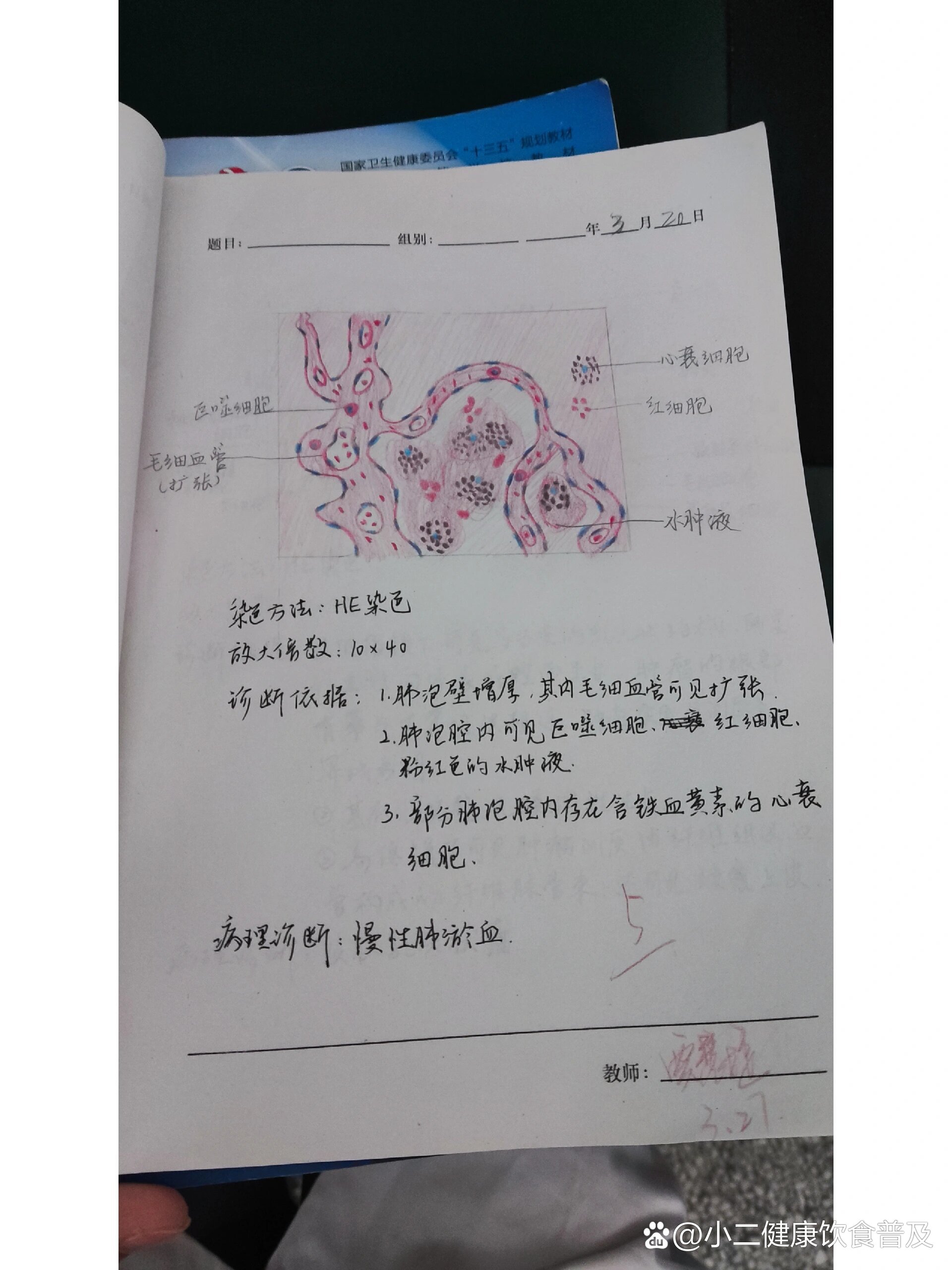 慢性肺淤血镜下实验图图片