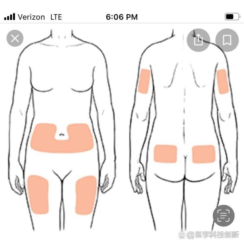 上交一次表格给医生 br>每天晚上自己打15units的胰岛素,我不敢打肚子