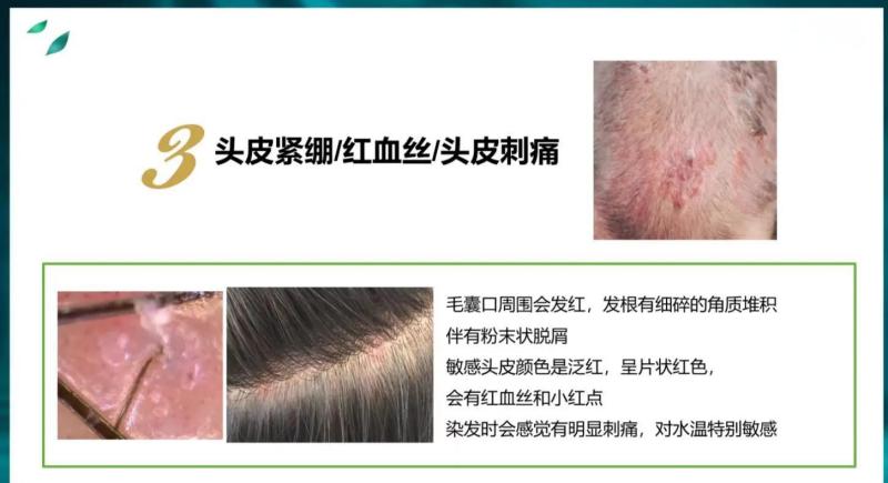 敏感头皮的那些事儿