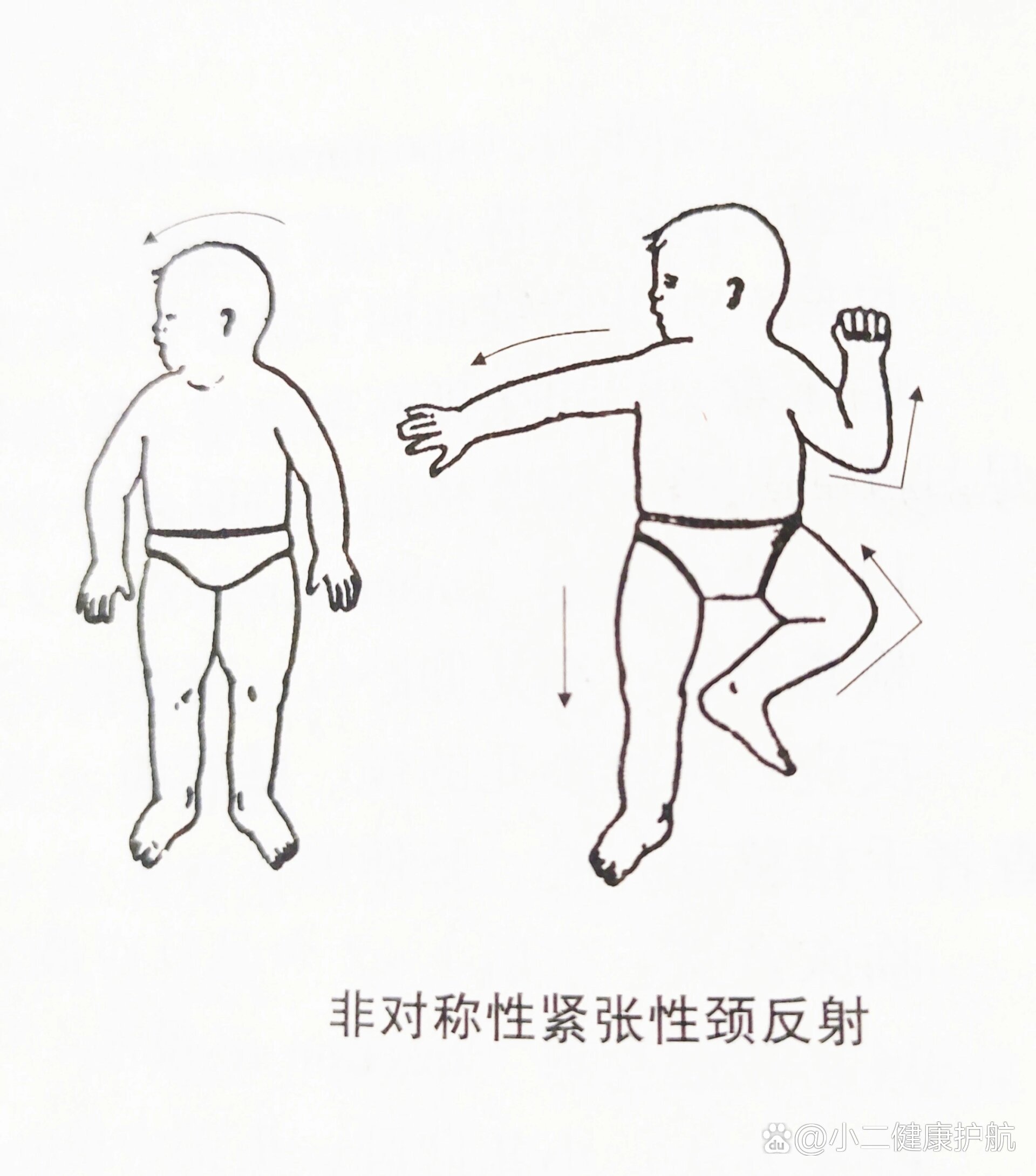 常见原始反射与反应(二):紧张性颈反射