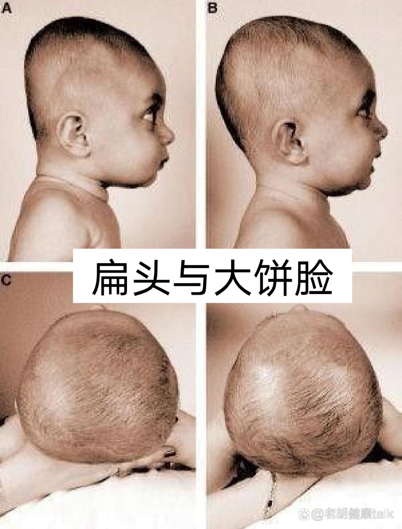 扁头与脸部美学结构的关系