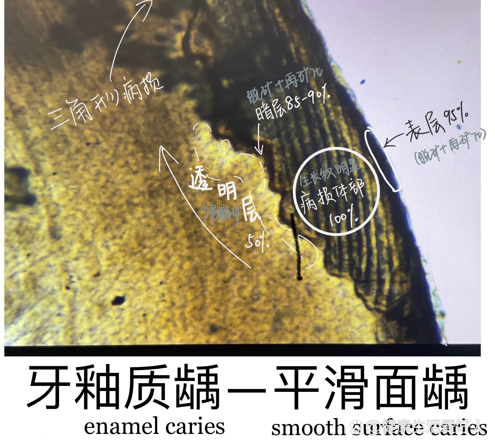 口腔组织病理切片绘图观察—龋病(釉质,本质