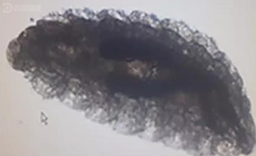 牧区男子擤鼻涕擤出两条虫,竟是因为蝇蛆寄生在鼻腔内——蝇蛆病
