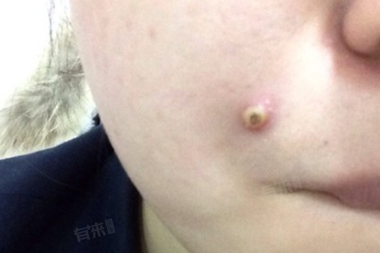 火疖子长什么样