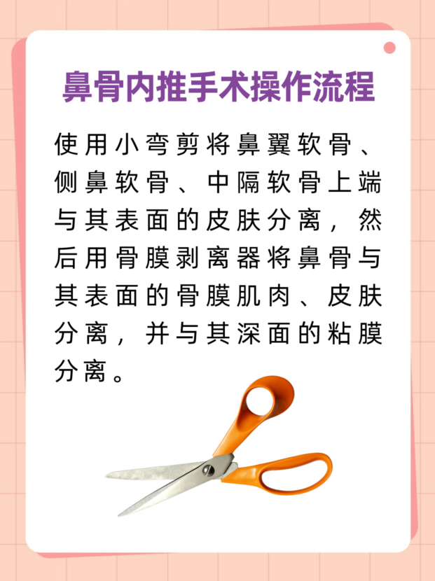 鼻骨内推手术费用大致多少?