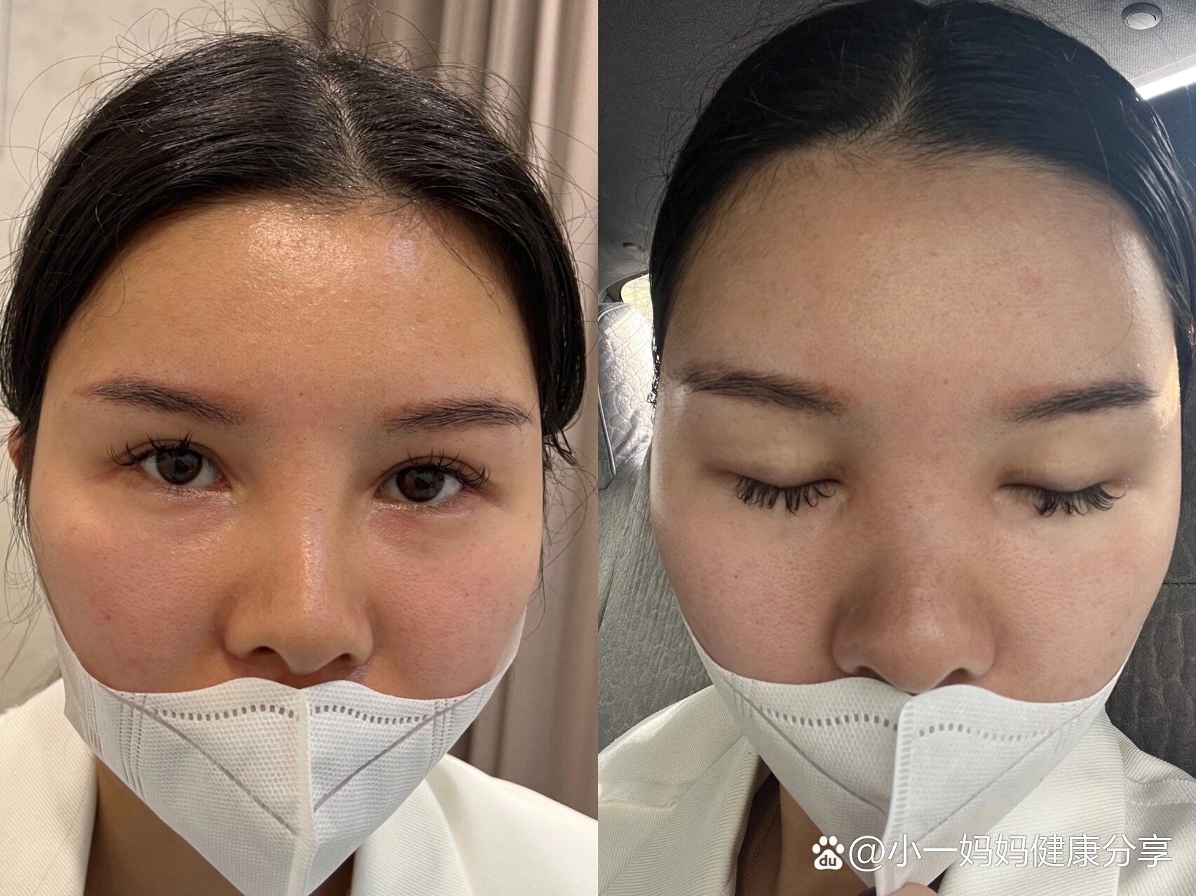 溶解酶也太神奇了吧这是打完第2天的效果,差不多已经完全稀释溶解没了