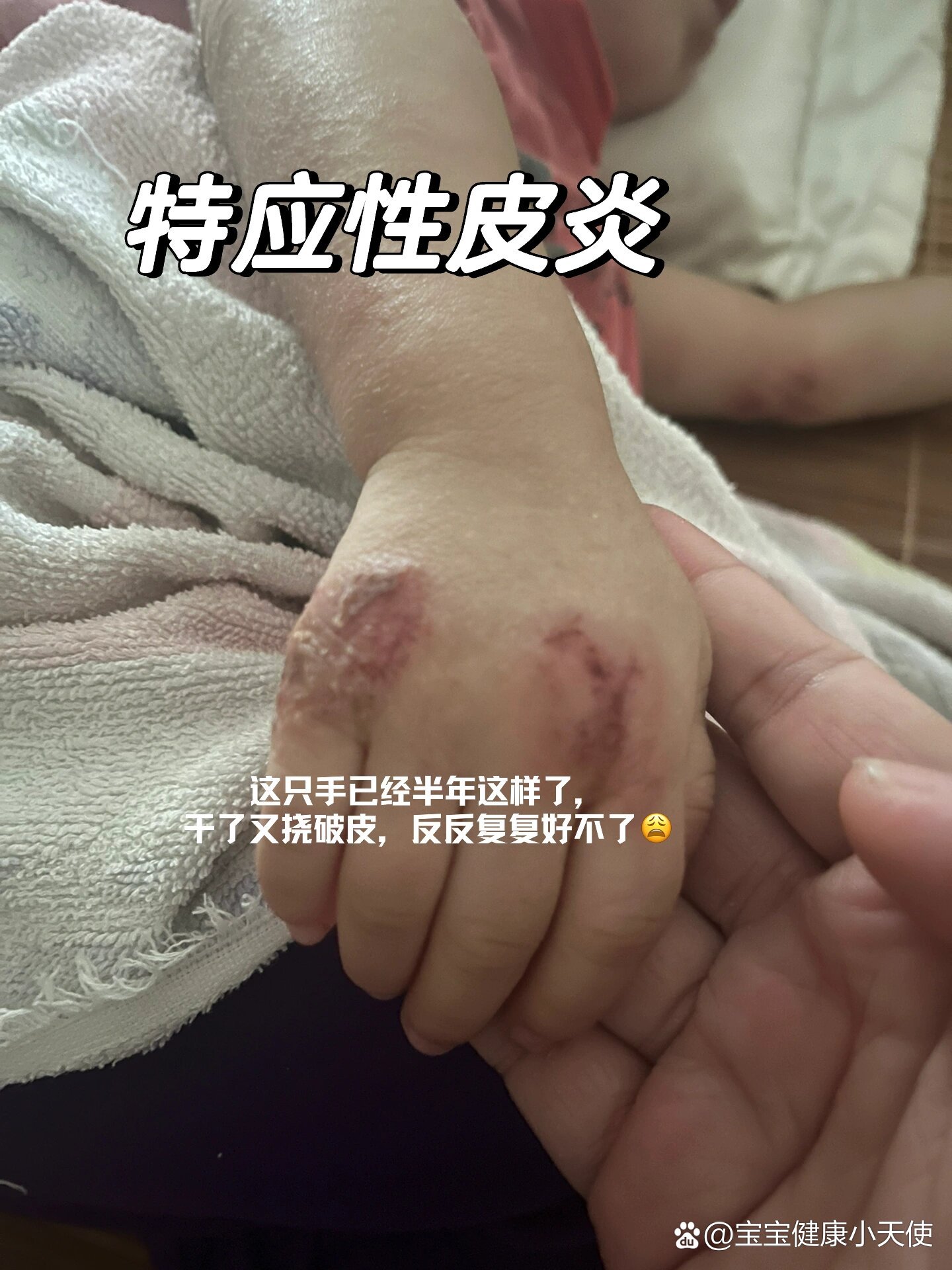 两岁半宝宝特应性皮炎