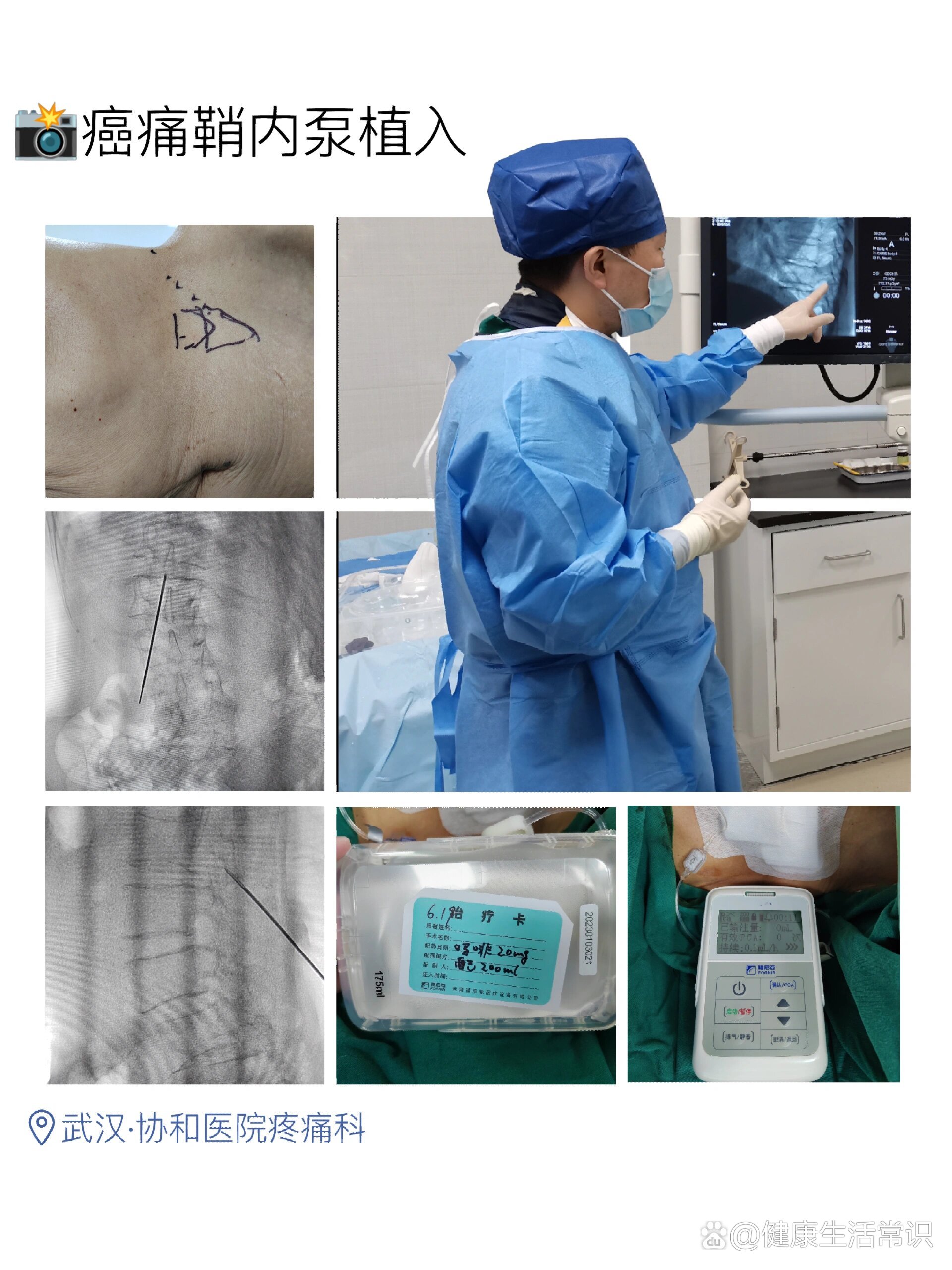 带大家了解下癌痛病人镇痛神器～鞘内吗啡泵