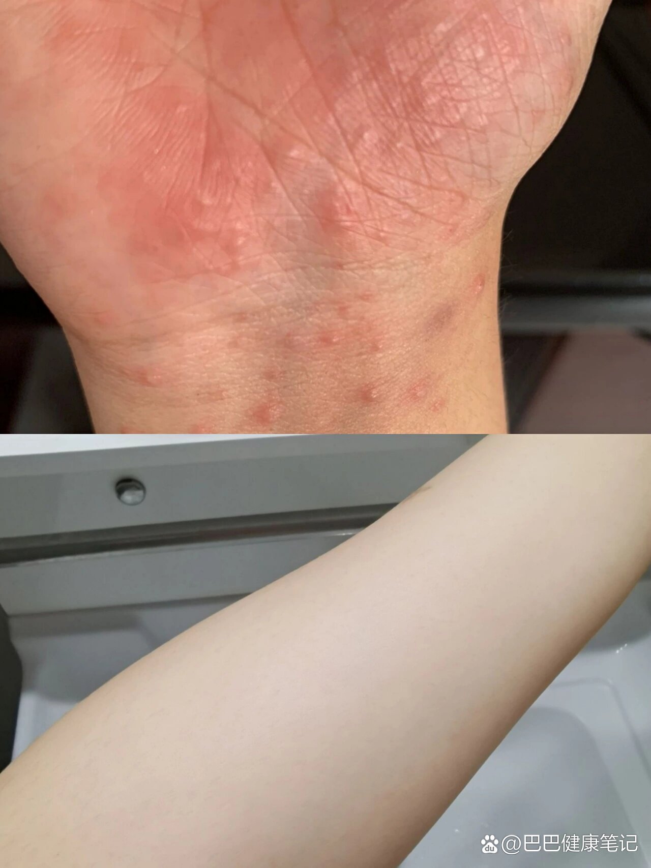 湿疹痊愈是因为用了青鹏软膏