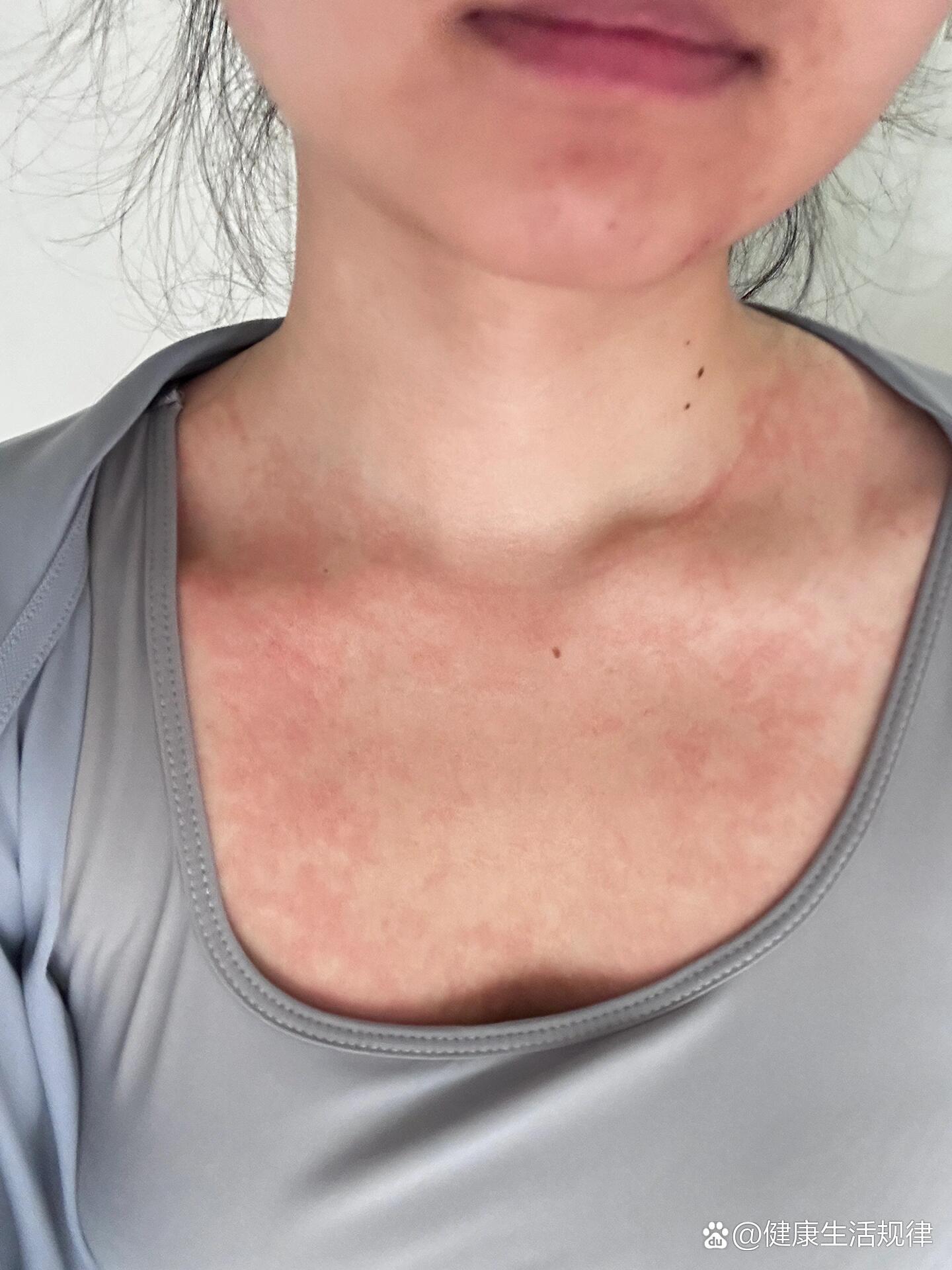 突然吃虾就过敏了