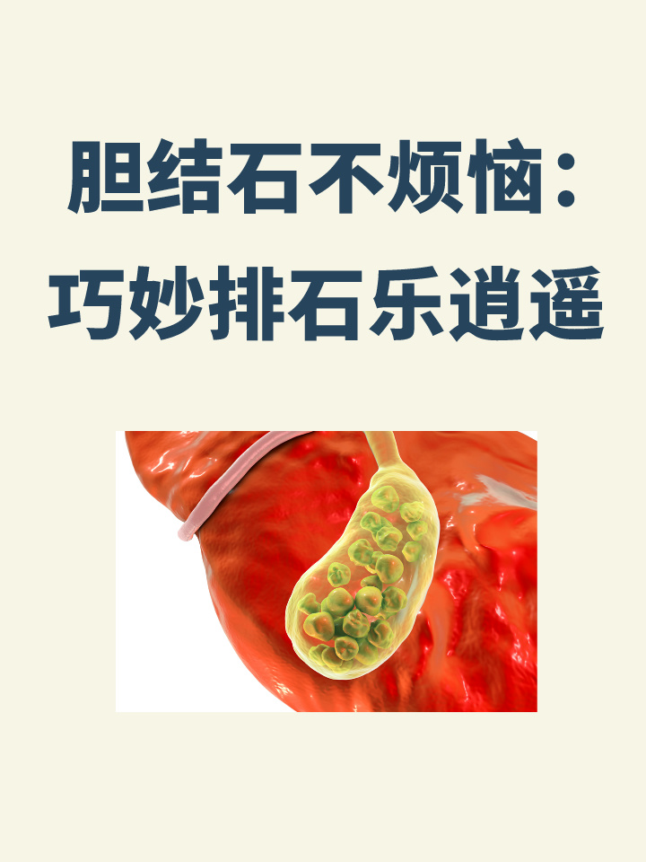 胆结石不烦恼:巧妙排石乐逍遥