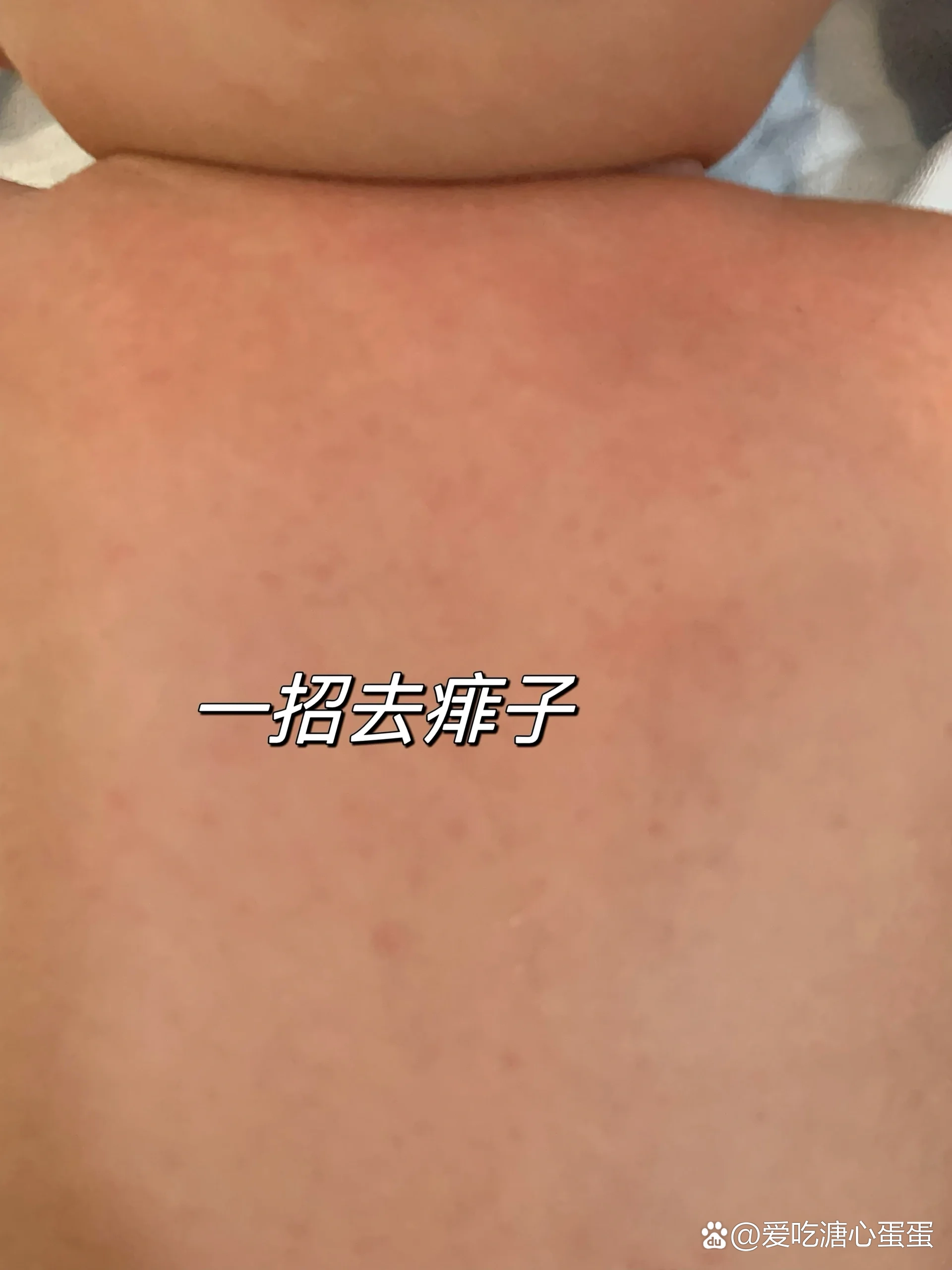 教你一招去痱子,小月龄宝宝也能用