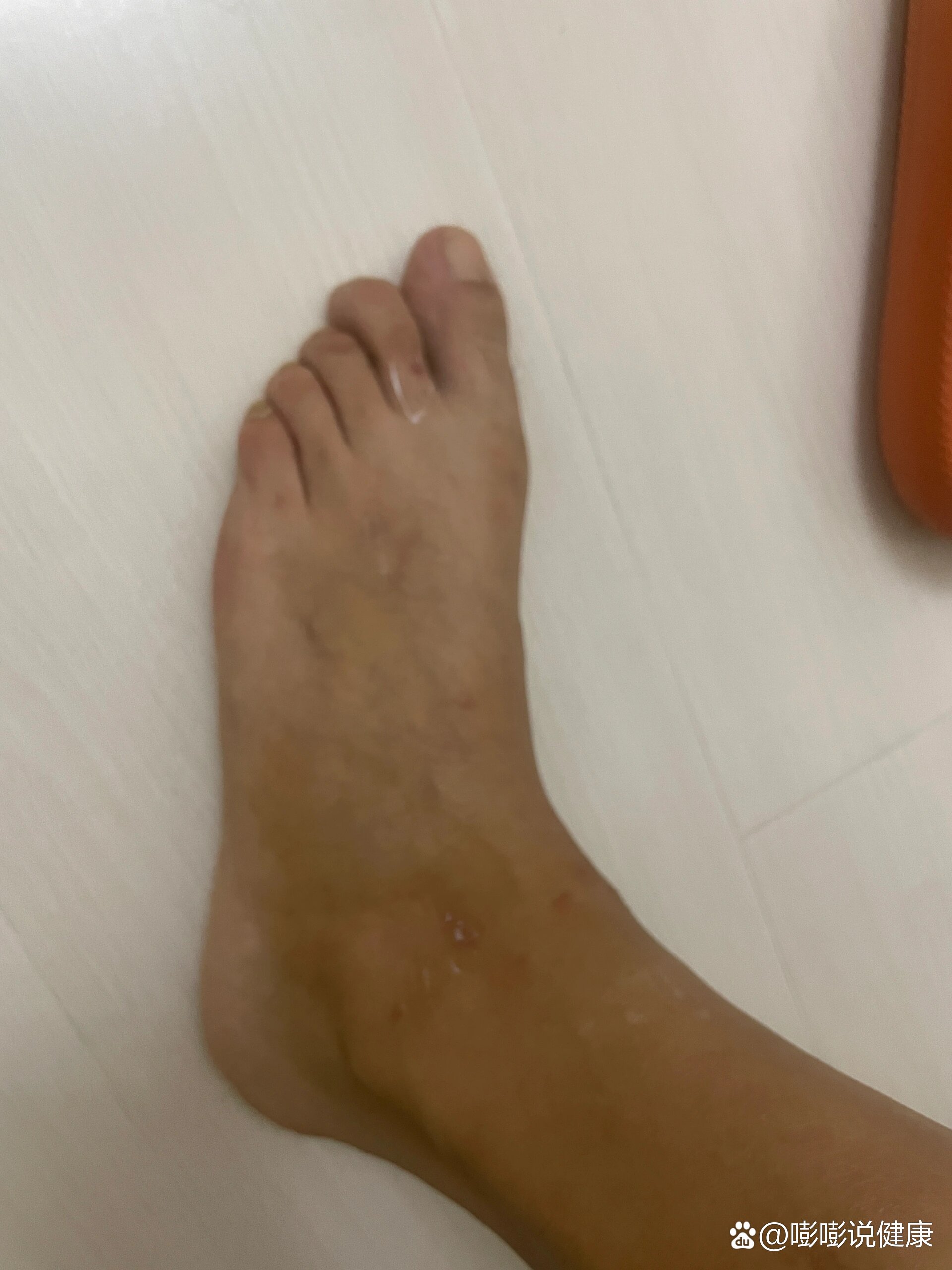 女儿脚背上发现有红点,巨痒无比.