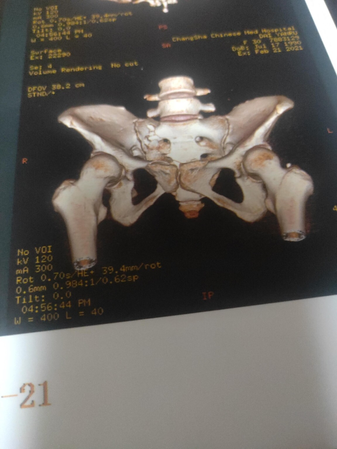 骶骨粉碎性骨折耻骨上下肢骨折