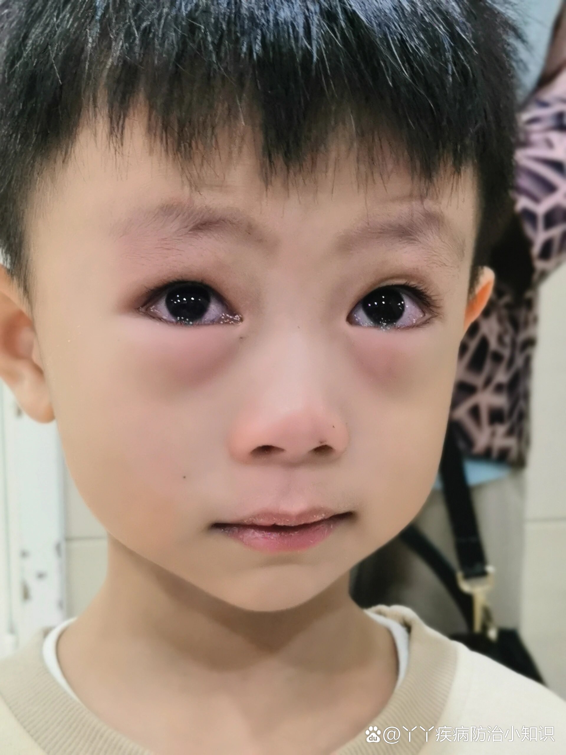 眼睛下面卧蚕的地方全都肿起来了,眼睛都睁不开了,眼睛里面也有点红