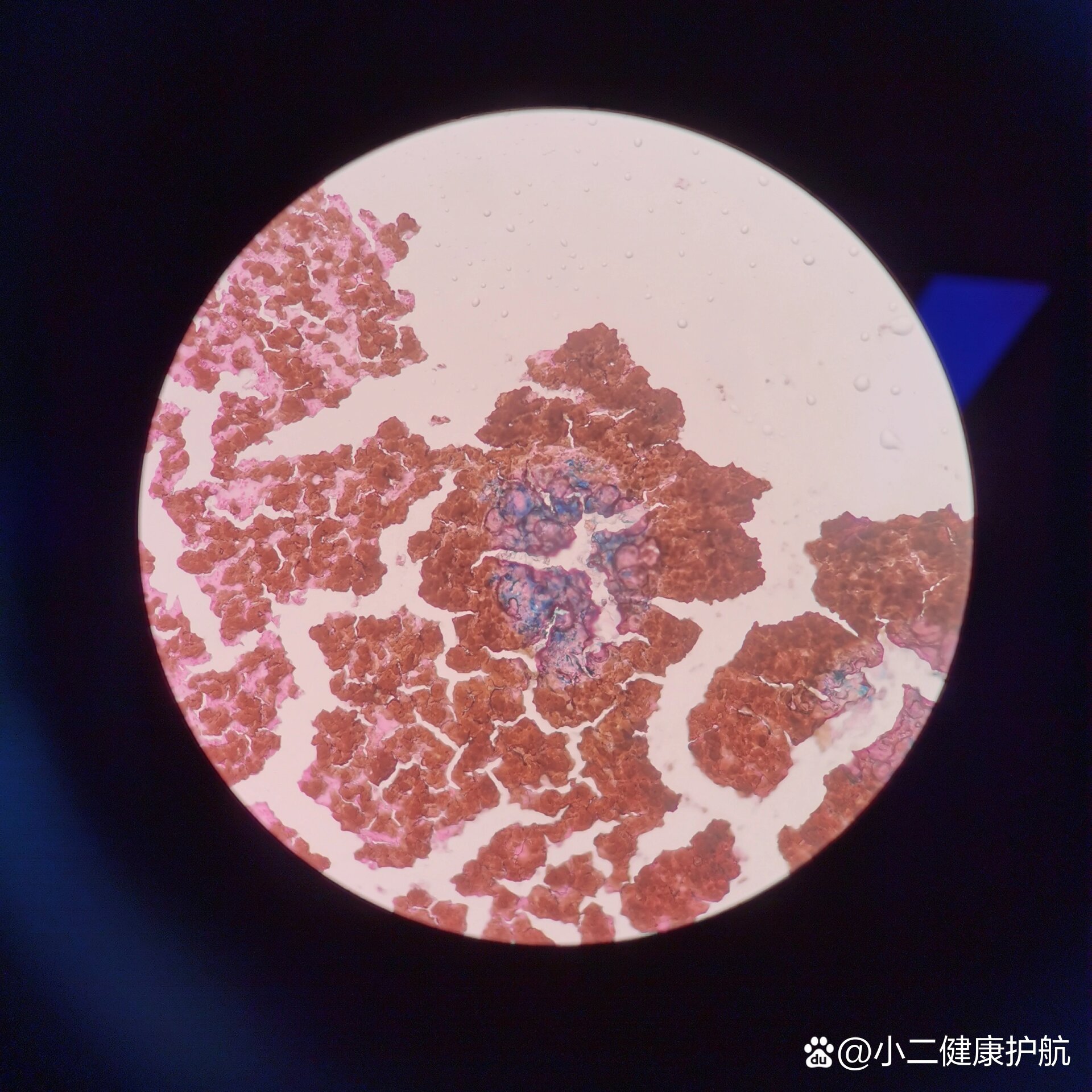 骨髓片铁染色 细胞外铁铁染色是临床应用最广泛的细胞化学染色