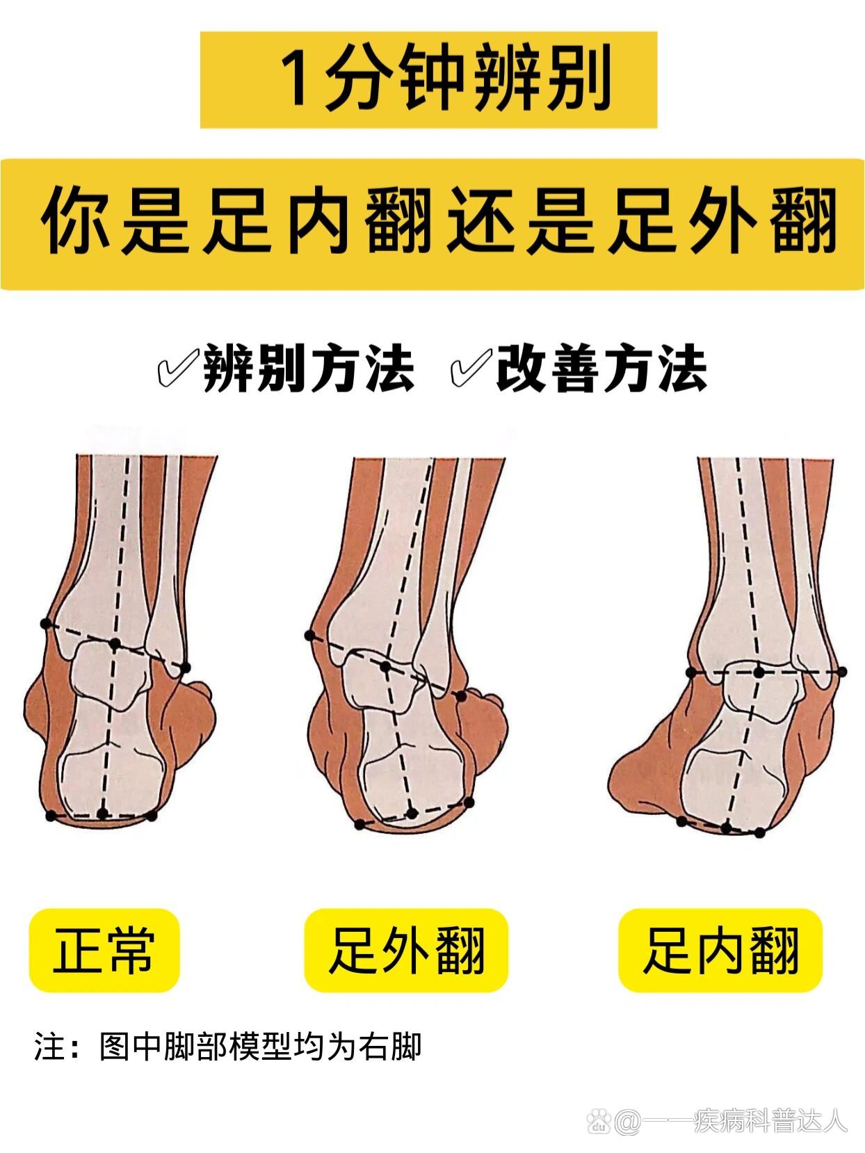 1分钟辨别你是足外翻还是足内翻!