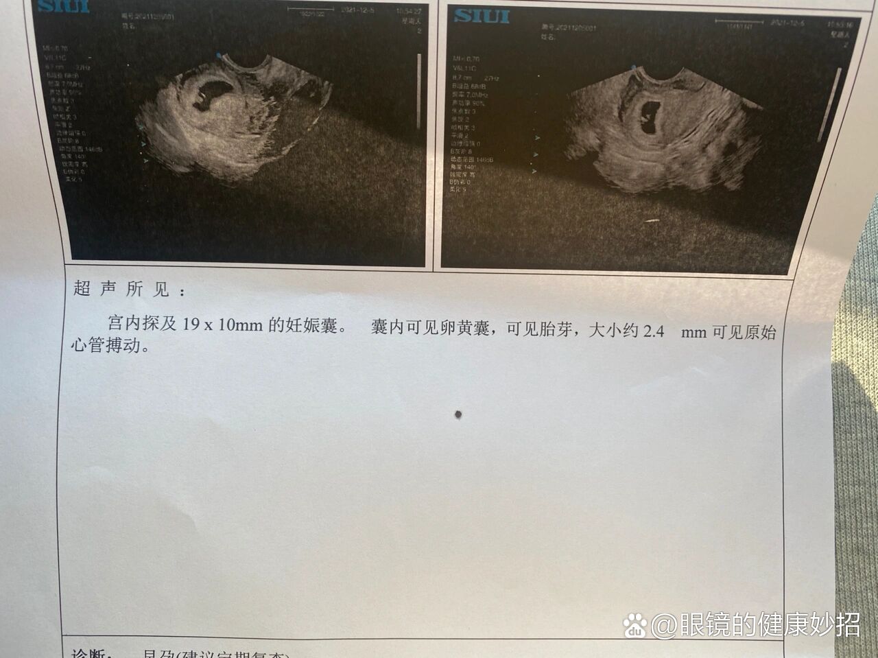 43天～热乎乎的胎心胎芽来啦～接好孕必有