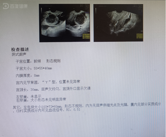 腹部不适发现附件肿物,行手术治疗,确诊黄体囊肿出血