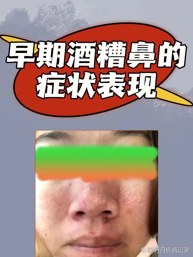黑头 闭口粉刺 毛孔粗大的姐妹一定要定期做好皮肤清洁 不然变成