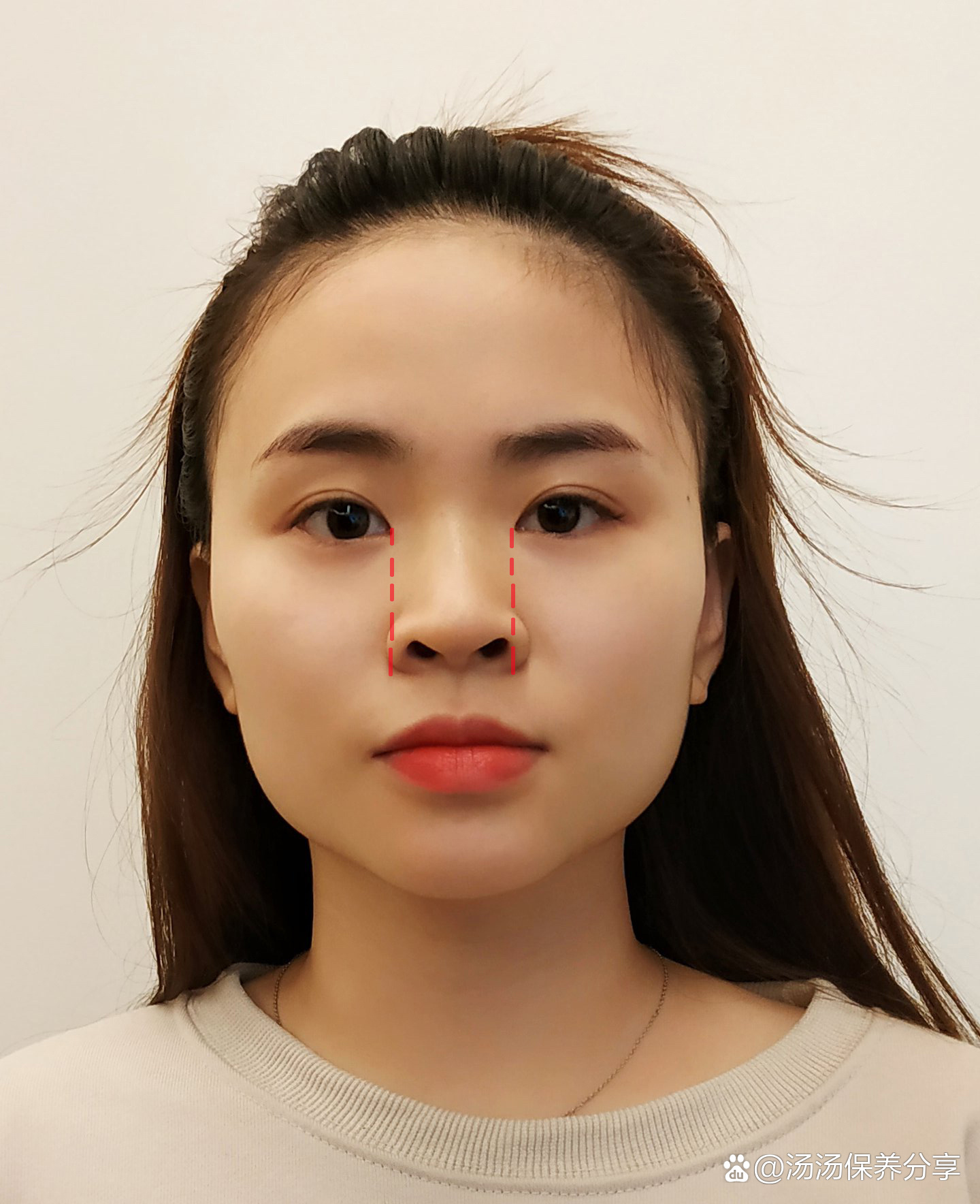 连明星都躲不了的鼻翼外扩,你中招了吗?