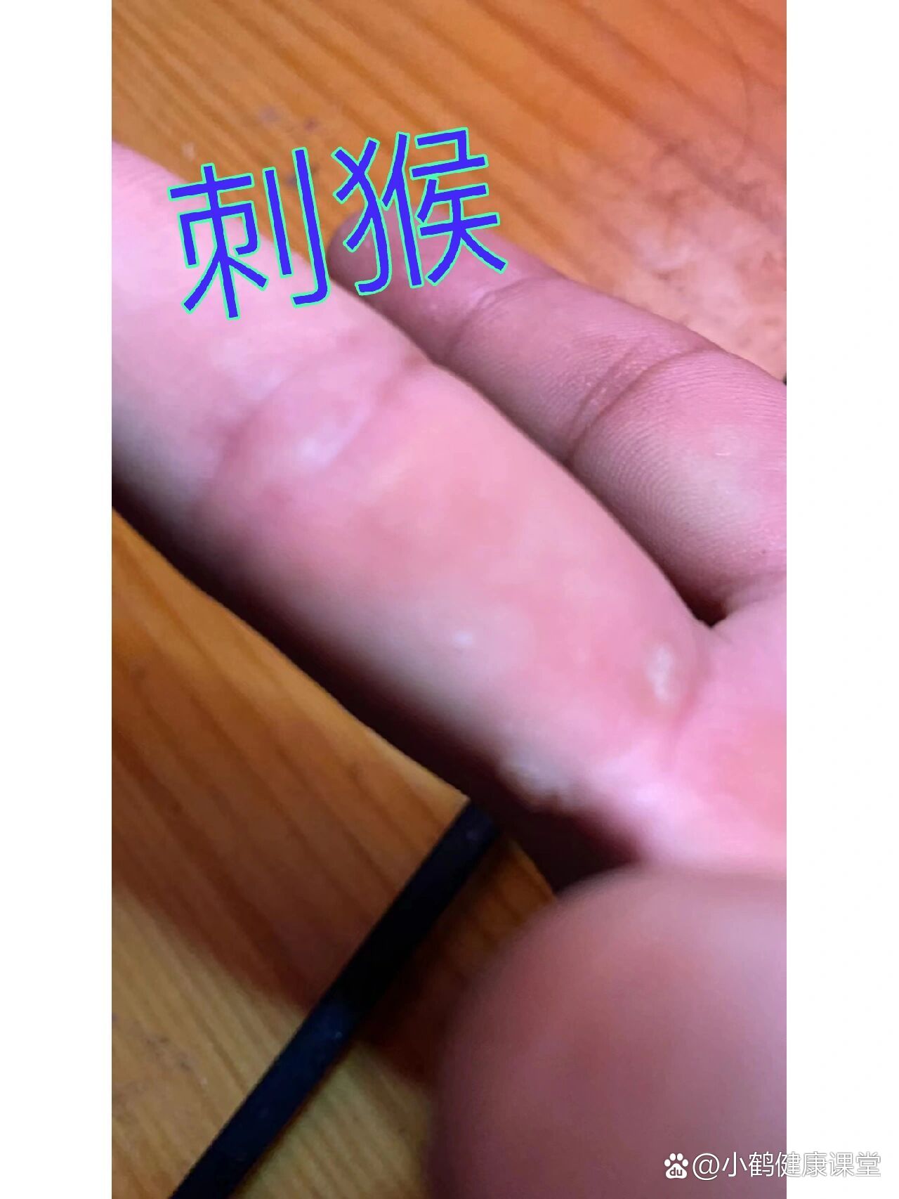 刺猴会传染吗图片