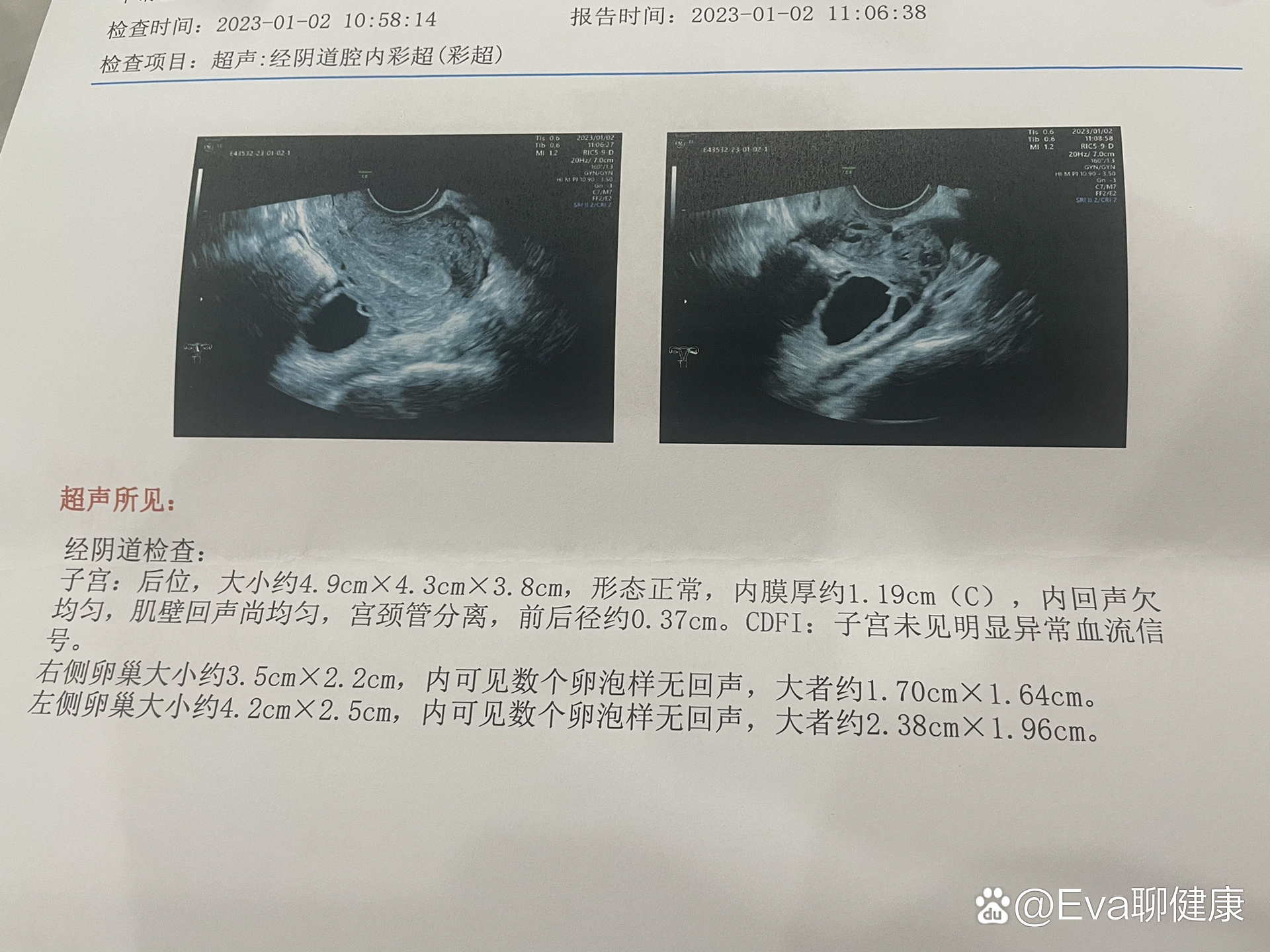 卵巢纤维瘤超声图片图片