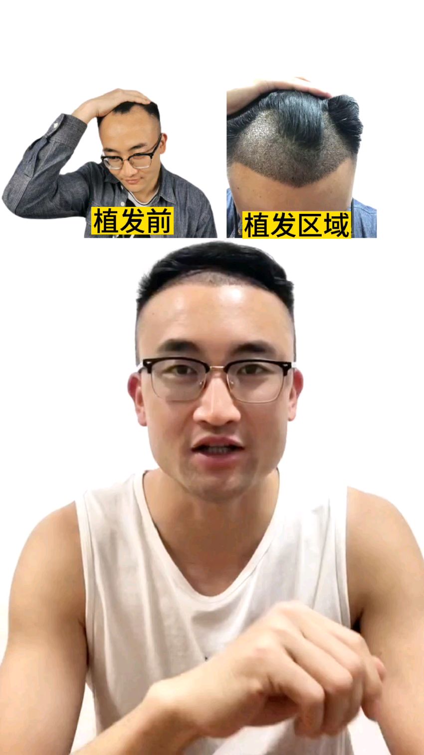 天生头顶头头发少能植发(天生头顶头头发少能植发嘛)