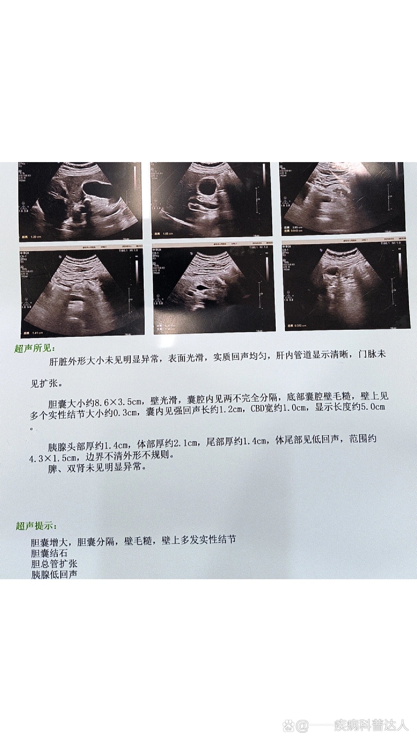 天津南开医院胆结石手术怎么样