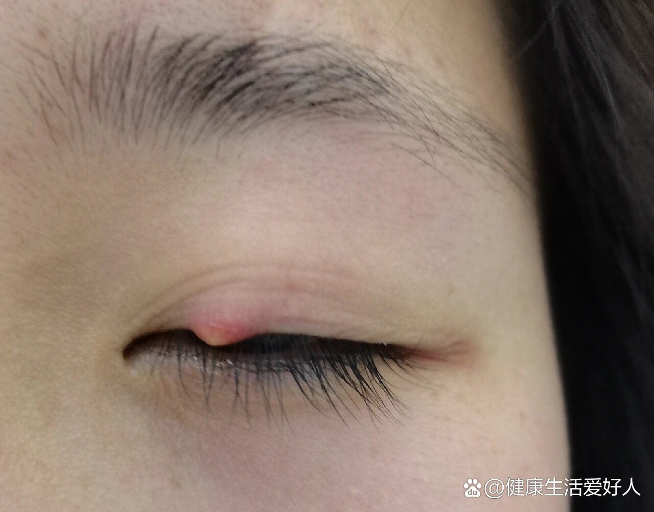 麦粒肿出现白色是快好了还是越来越严重啦