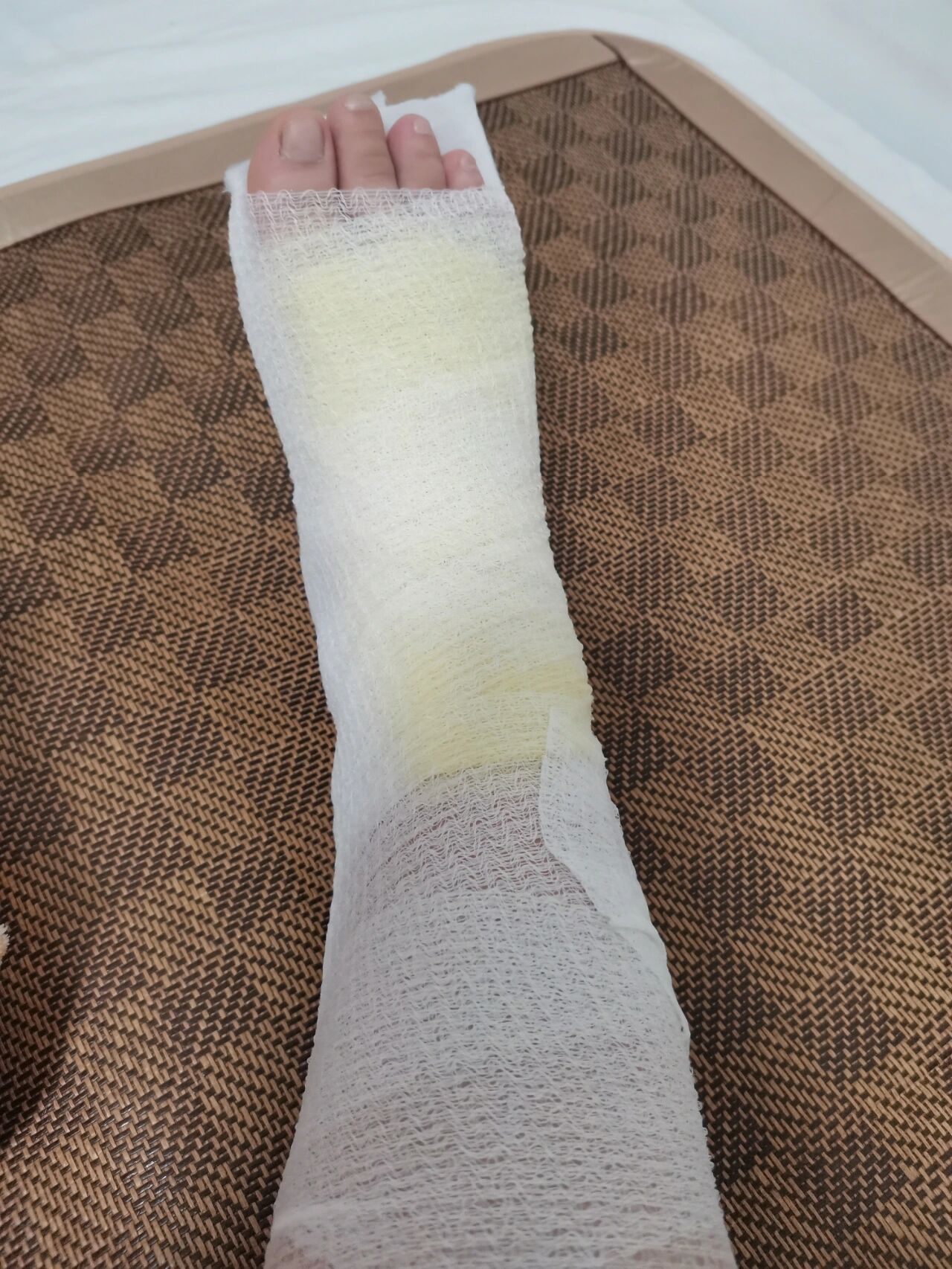 什么变化,但是已经消肿很多啦,绷带都松了不少消炎药终于可以停啦