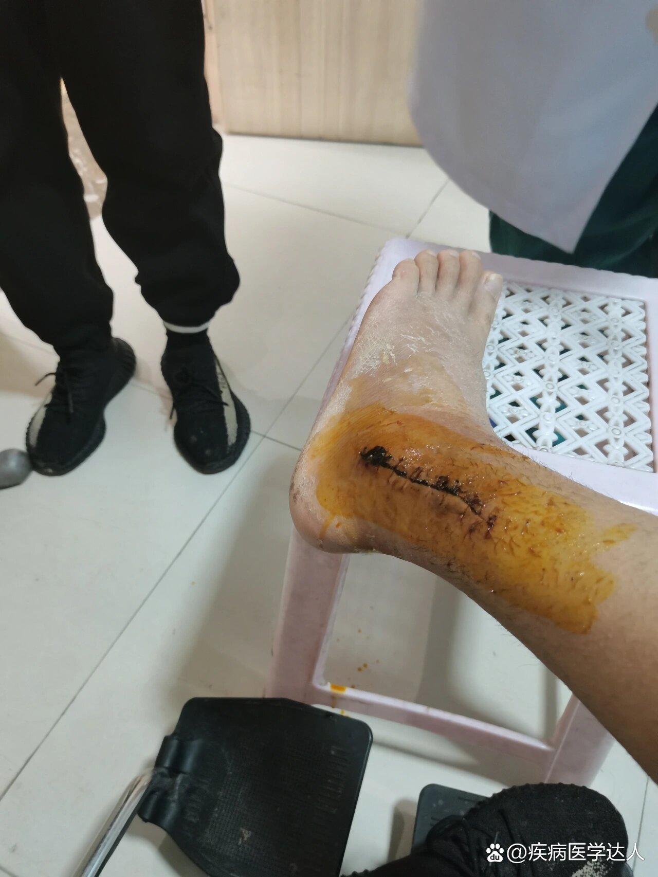 三踝骨折术后18天