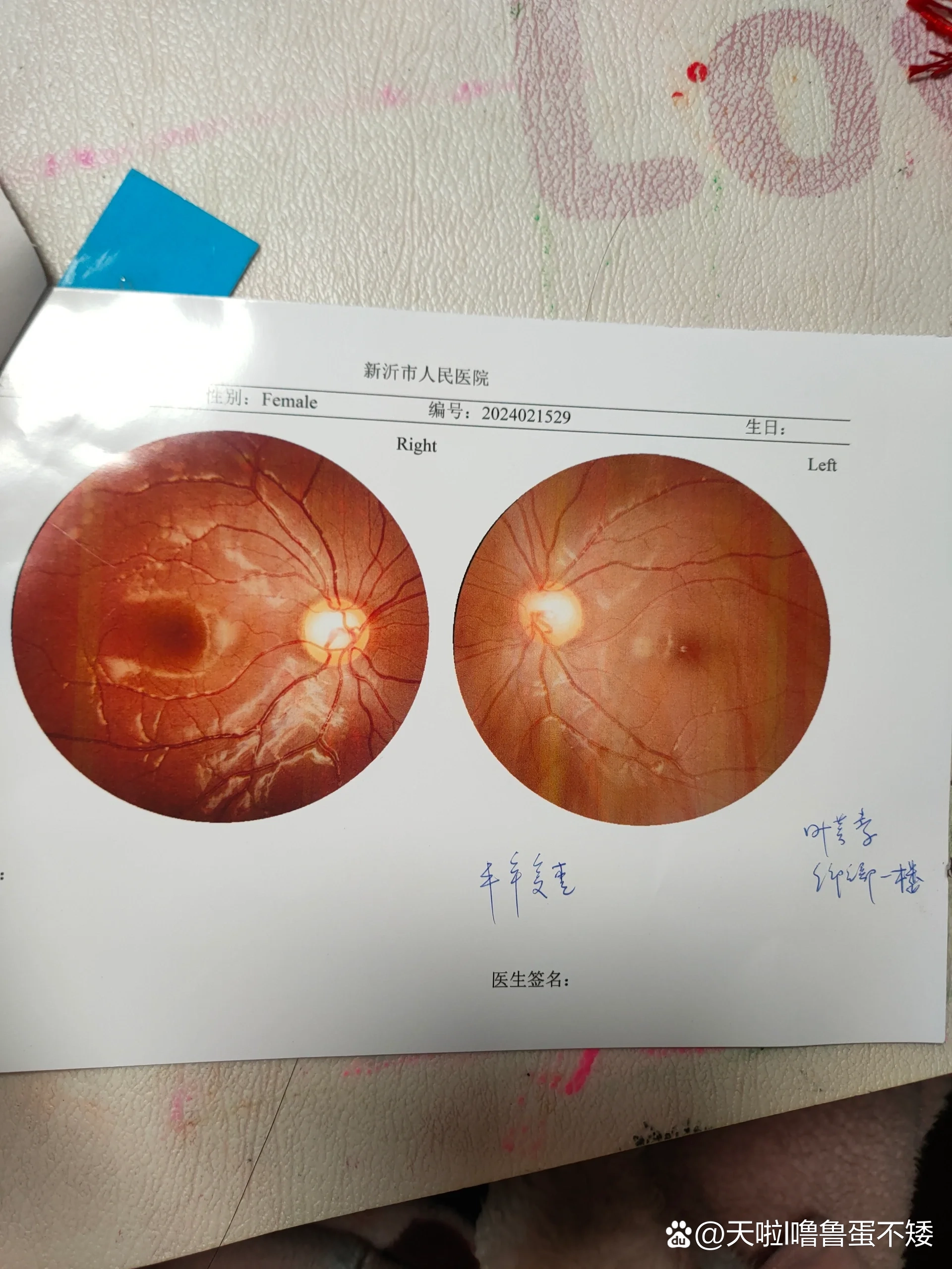 不用散瞳的眼底检查