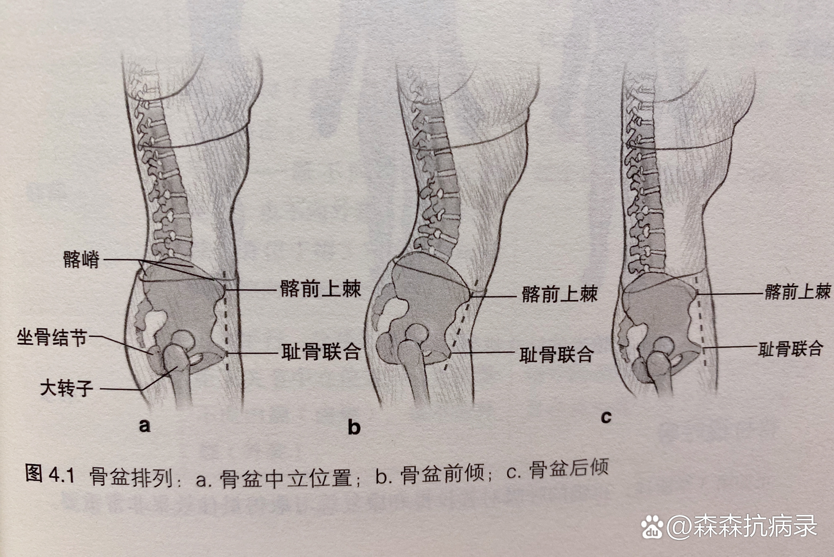 骨盆前倾角度图片