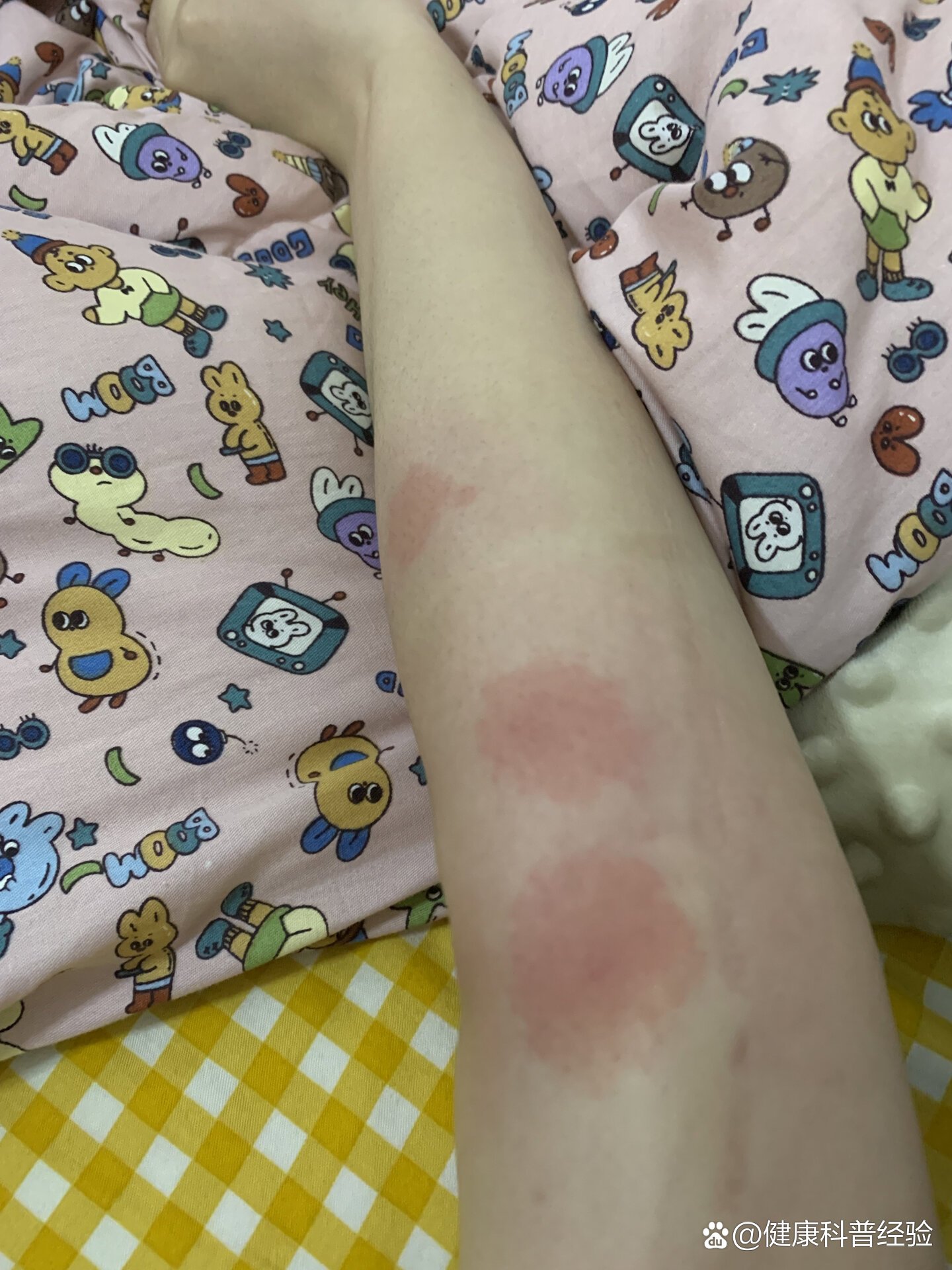 在海南被蚊虫叮咬