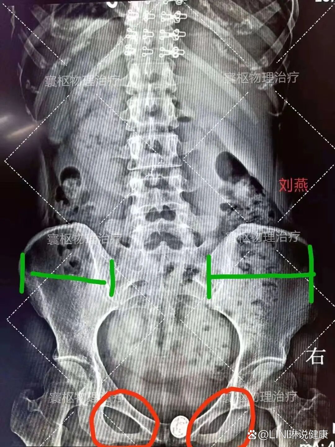 耻骨分离图片 x光片图片