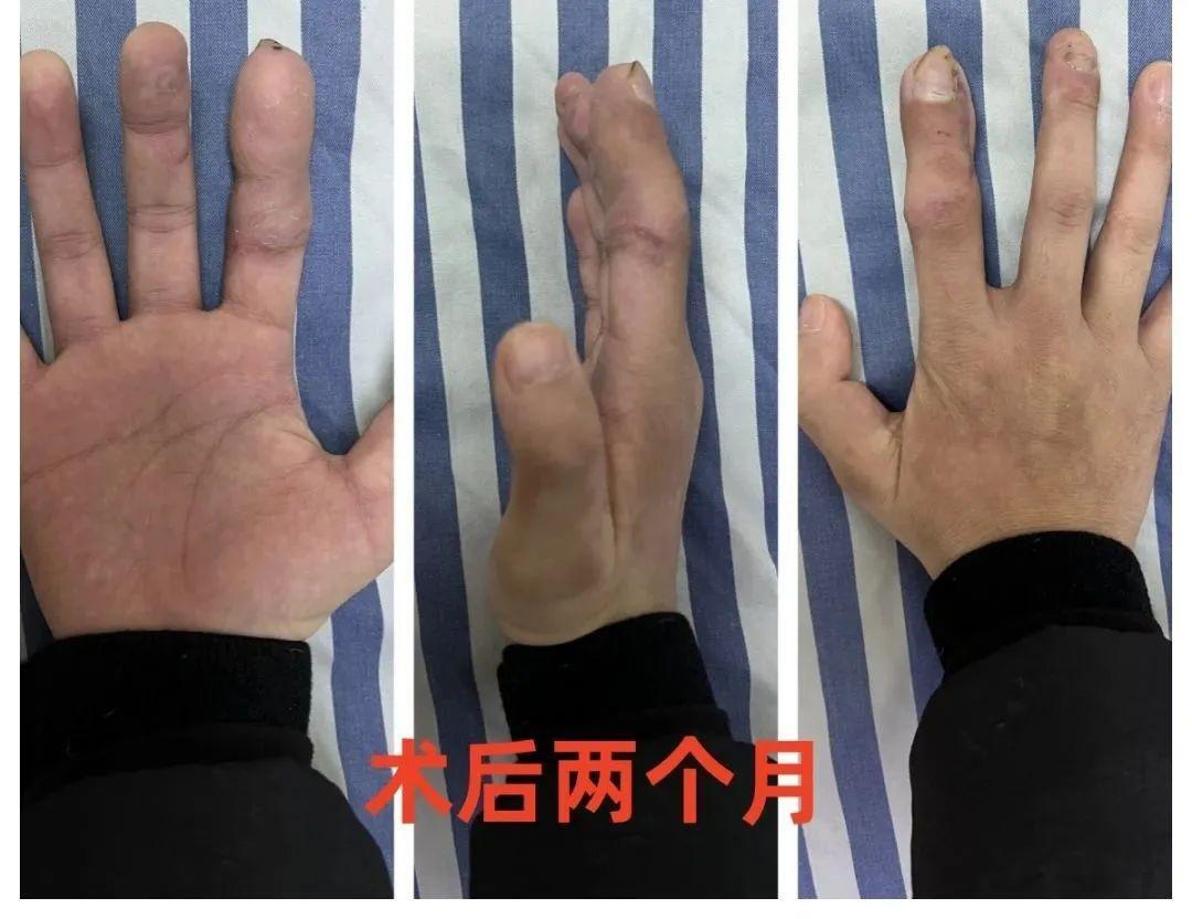 手指不幸离断"全形再造术"还伤者健全手指