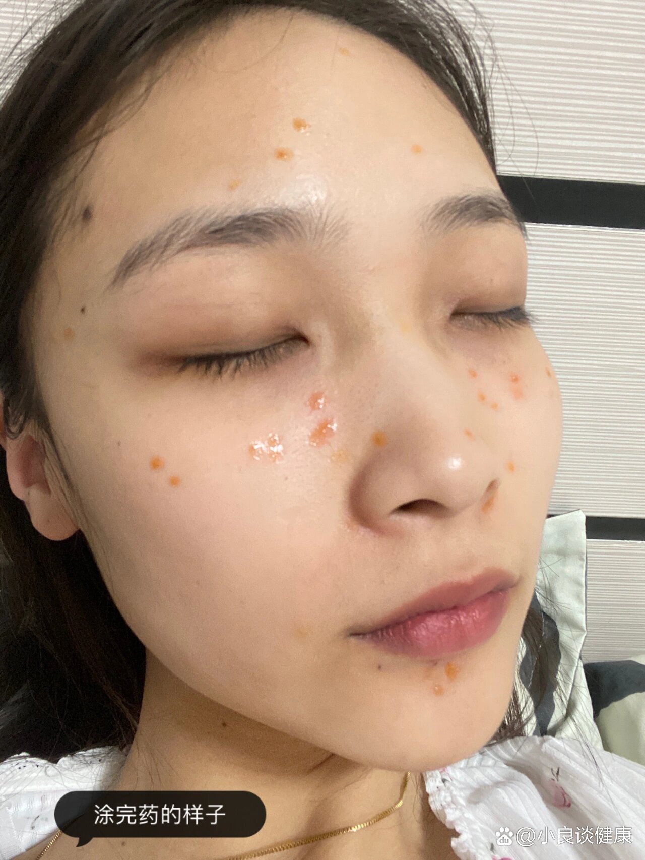 黑头 粉刺 痤疮克星 br>安茉平 克痤隐酮凝胶 红黄色透明的凝胶型 6克