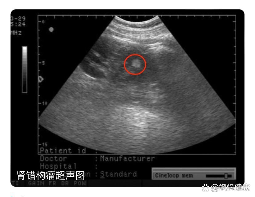 肾部错构瘤图图片