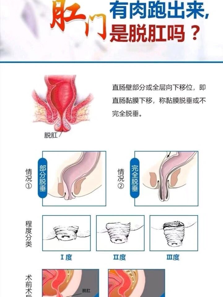 肛门异物怎么取出来图片