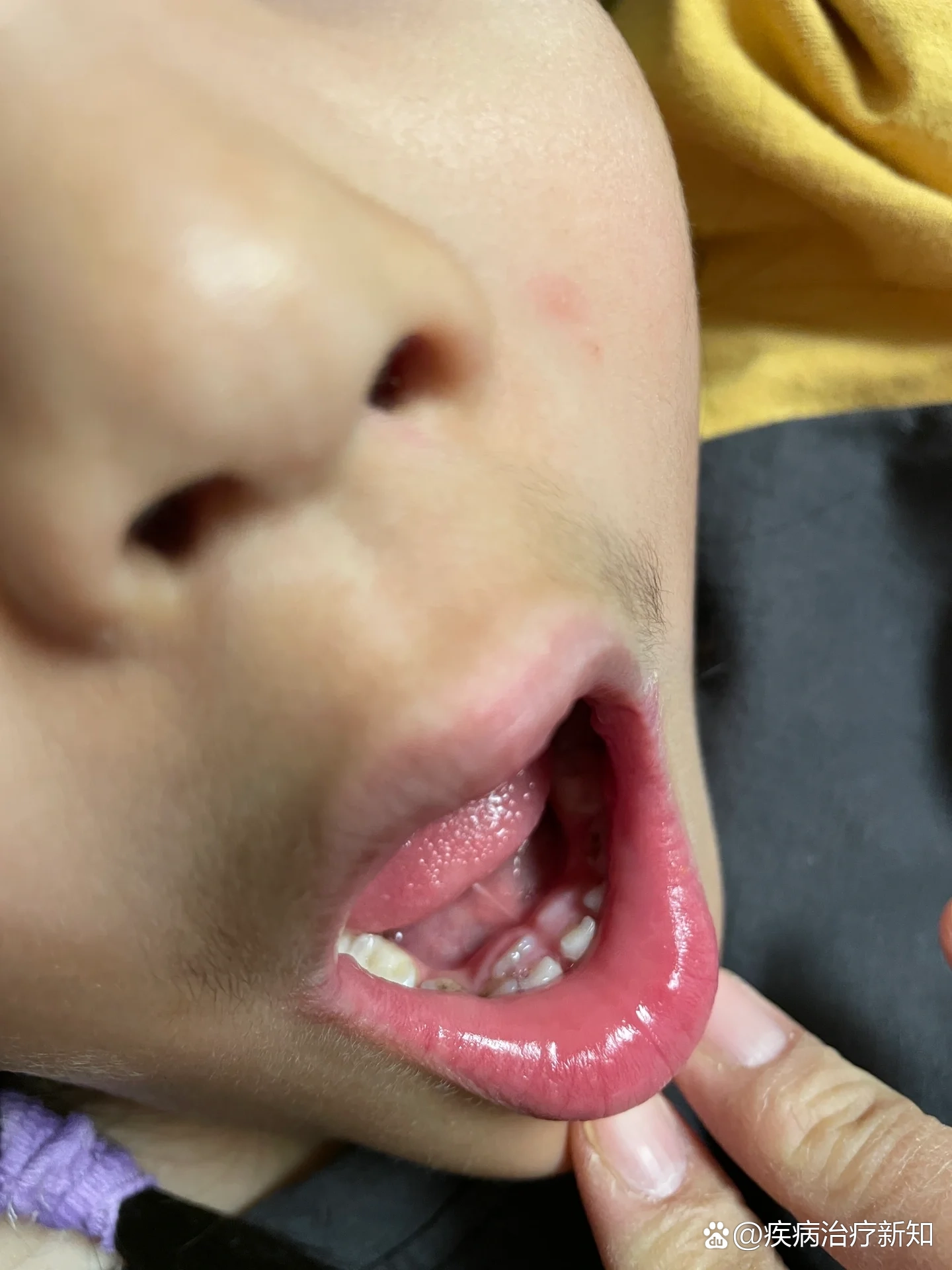 乳牙滞留果断拔掉75拔牙全过程及注意事项