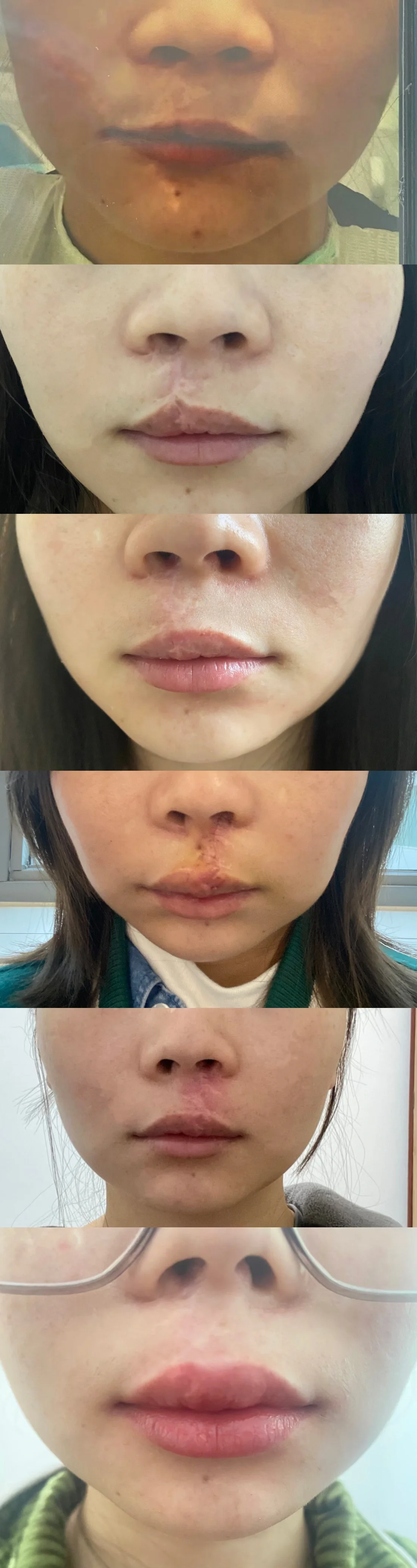 唇腭裂二期术后