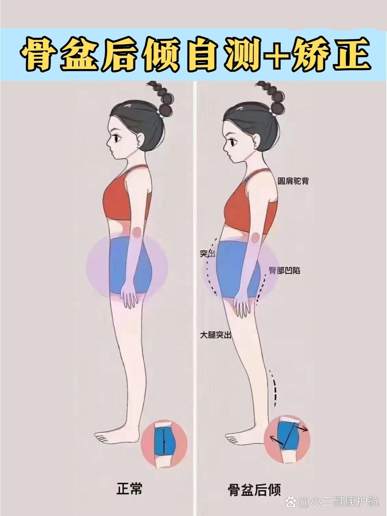 骨盆后倾❗️别让它毁了你的体态❗️❗️